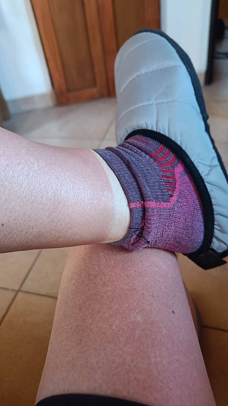 sunburnt legs 